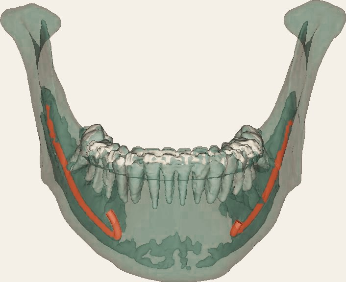 Lower jaw shown as transparent, with both inferior alveolar nerves traced through it in a warm color from the back of the jaw to the chin