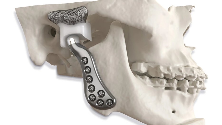 Custom total joint replacement on a skull model, with the socket component at the base of the skull and the condylar component fixed to the lower jaw with screws