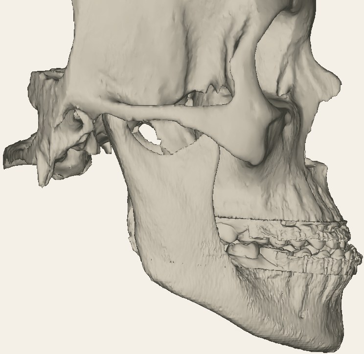 Three-dimensional model of the patient's skull and jaws before surgery