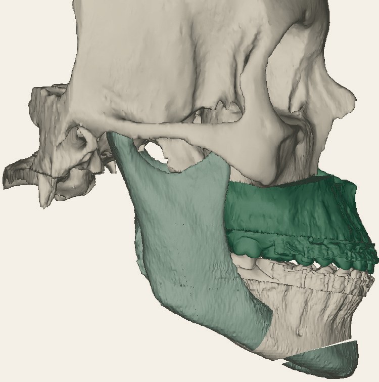 The same skull with the upper jaw, lower jaw, and chin repositioned in the virtual surgical plan